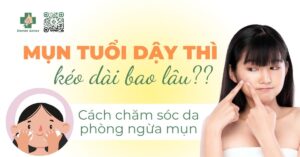 Mụn tuổi dậy thì kéo dài bao lâu?