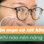 Nặn mụn có tốt không? Khi nào nên nặn mụn?
