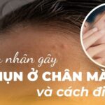 Nguyên nhân gây nổi mụn ở chân mày và cách điều trị