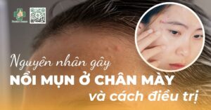 nguyên nhân gây nổi mụn ở chân mày