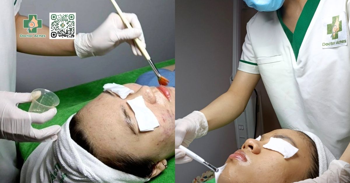 peel da tại phòng khám Doctor Acnes