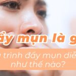 Đẩy mụn là gì? Quá trình đẩy mụn diễn ra như thế nào?