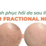 Quá trình hồi phục da sau liệu trình laser fractional Nd:YAG