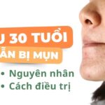 Sau 30 tuổi vẫn bị mụn: nguyên nhân và cách điều trị