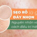 Sẹo rỗ đáy nhọn là gì? Nguyên nhân và cách điều trị hiệu quả
