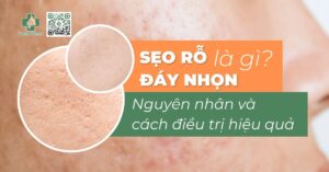 Sẹo rỗ đáy nhọn là gì? Nguyên nhân và cách điều trị hiệu quả