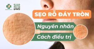 sẹo rỗ đáy tròn nguyên nhân và cách điều trị