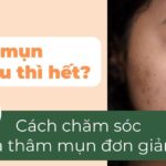 Thâm mụn bao lâu thì hết? Cách trị thâm mụn đơn giản và nhanh chóng