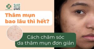 Thâm mụn bao lâu thì hết? Cách chăm sóc da thâm mụn đơn giản