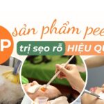 Top sản phẩm peel da trị sẹo rỗ hiệu quả