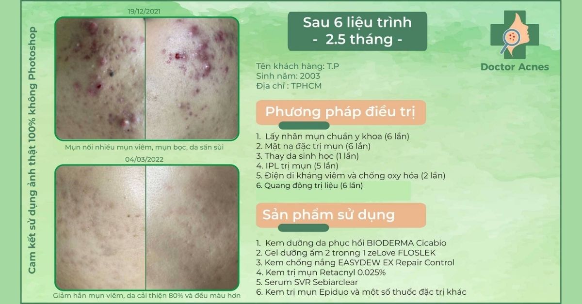 ca lâm sàng điều trị dùng retacnyl