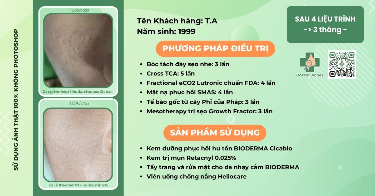 ca lâm sàng điều trị sẹo rỗ thành công