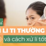 Các loại mụn li ti thường gặp và cách xử lý tốt nhất