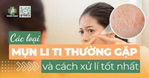 Các loại mụn li ti thường gặp và cách xử lý tốt nhất