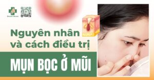 mụn bọc ở mũi