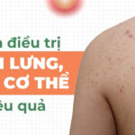 Nguyên nhân và cách điều trị mụn lưng hiệu quả
