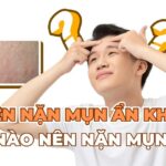 Có nên nặn mụn ẩn không? Khi nào nên nặn mụn ẩn?
