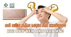 Có nên nặn mụn ẩn không? Khi nào nên nặn mụn ẩn?