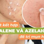 Bí quyết kết hợp adapalene và azelaic acid để trị mụn hiệu quả