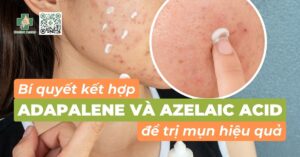 Bí quyết kết hợp adapalene và azelaic acid để trị mụn hiệu quả