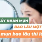 Nên lấy nhân mụn bao lâu một lần? Nặn mụn bao lâu thì lành?