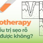 Mesotherapy có điều trị sẹo rỗ được không?