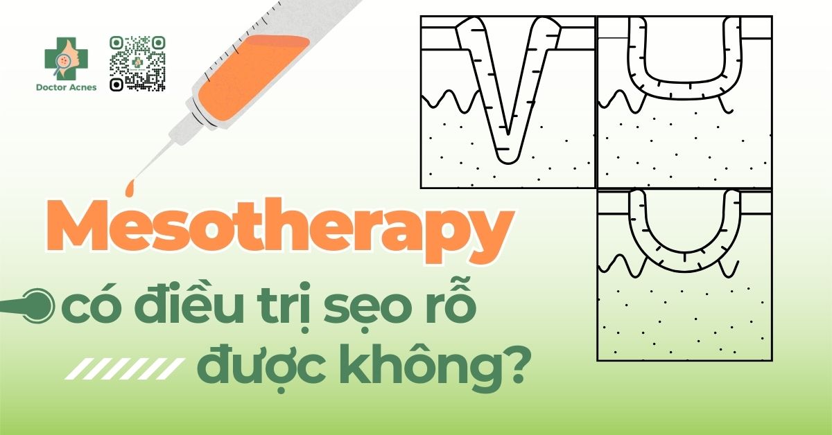 tiêm meso có trị sẹo rỗ không