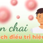 Mụn chai là gì? Cách điều trị mụn chai hiệu quả