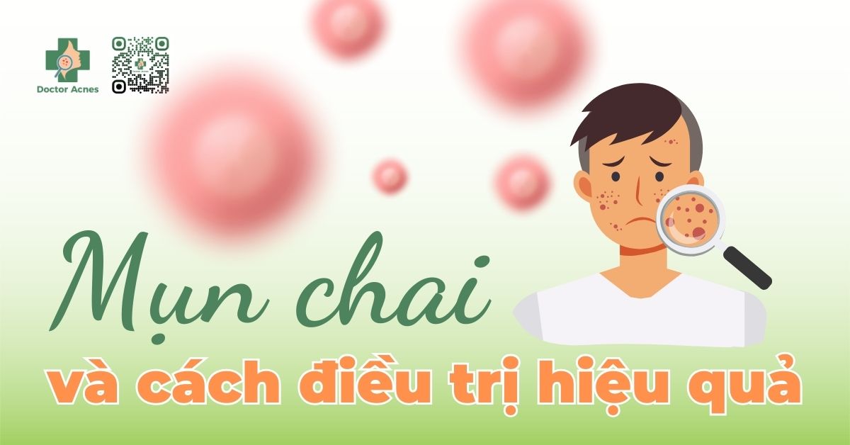 Mụn chai là gì? Cách điều trị mụn chai hiệu quả hiện nay