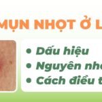 Mụn nhọt ở lưng: dấu hiệu, nguyên nhân và cách điều trị