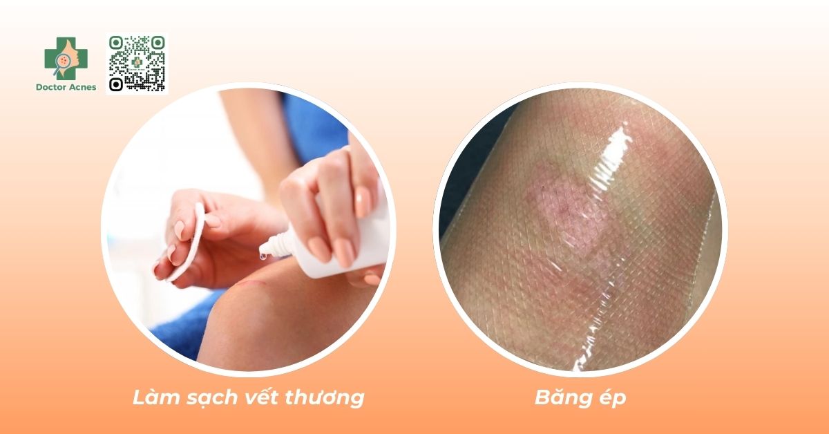 ngừa sẹo lồi bằng chăm sóc vết thương