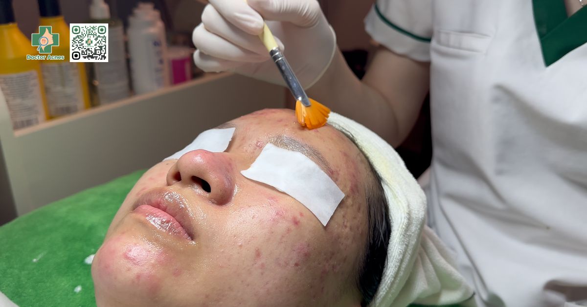 phối hợp bha với aha trong peel da