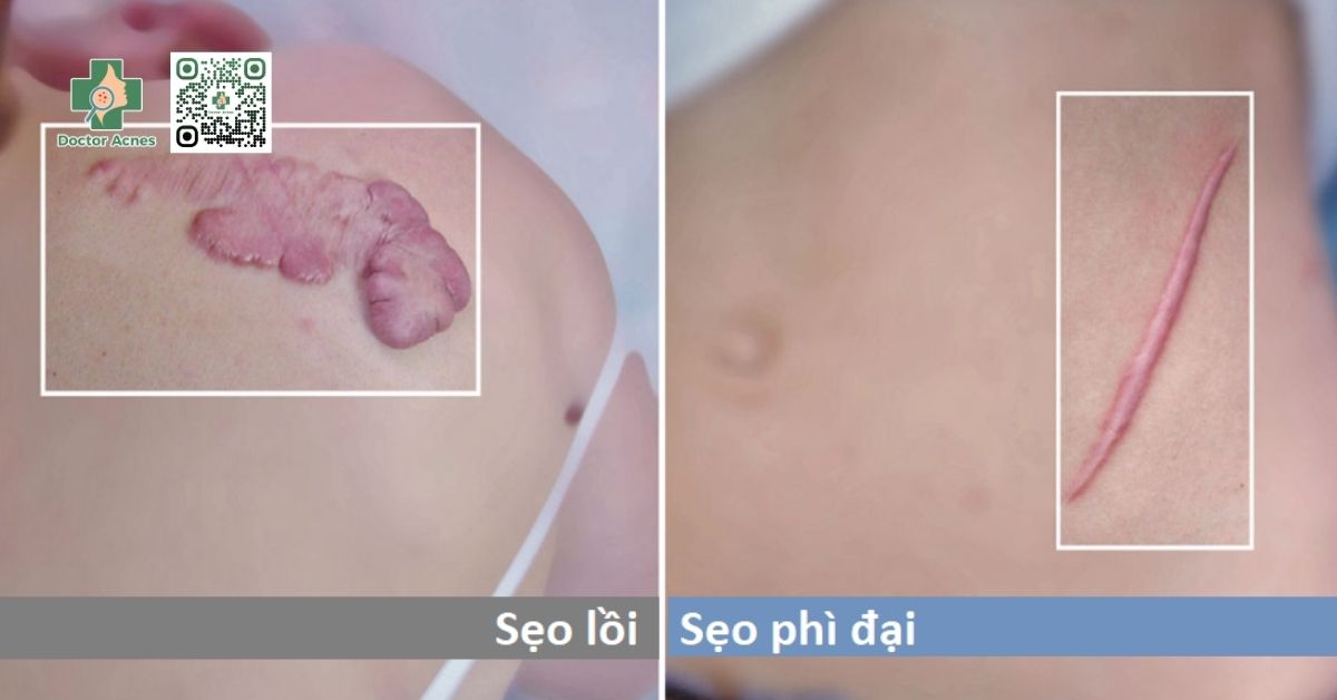 sẹo phì đại và sẹo lồi