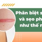 Phân biệt sẹo lồi và sẹo phì đại như thế nào?