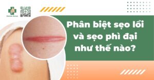 Phân biệt sẹo lồi và sẹo phì đại như thế nào?