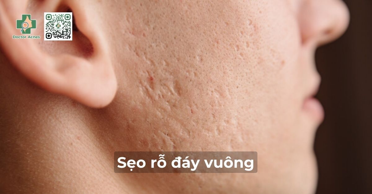 sẹo rỗ đáy vuông là gì