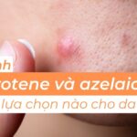 So sánh tazarotene và azelaic acid: lựa chọn nào cho da mụn?