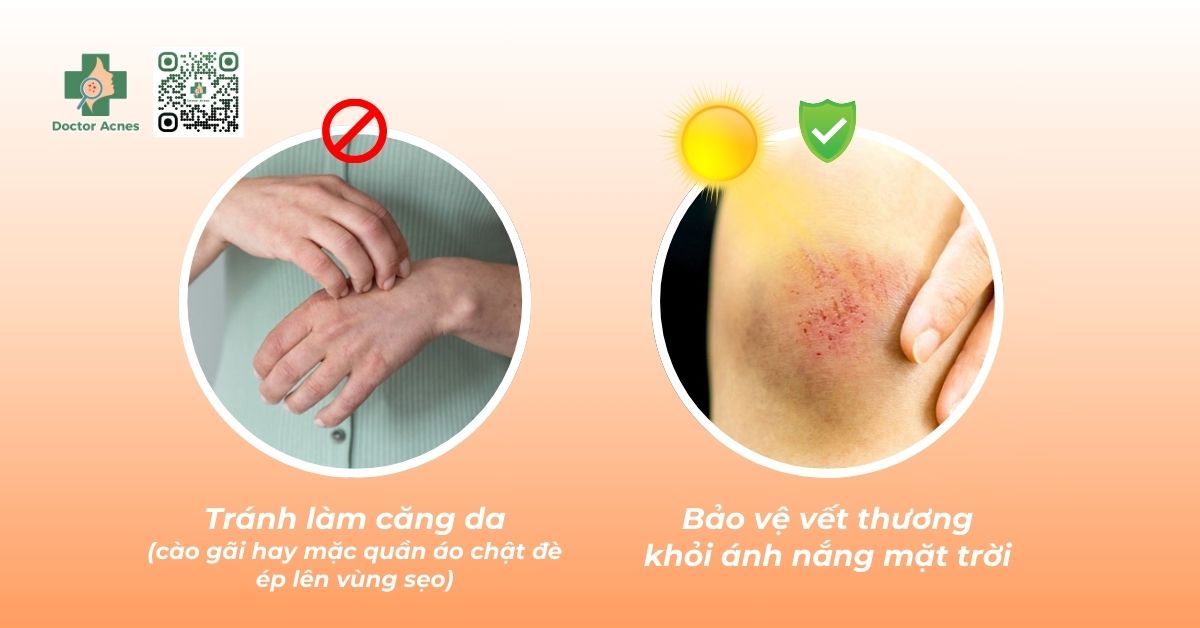 tránh các yếu tố kích thích để ngừa sẹo lồi