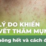 8 lý do khiến vết thâm mụn mãi không hết và cách điều trị