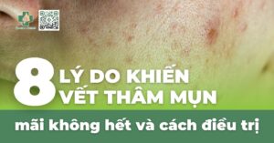 8 lý do khiến vết thâm mụn mãi không hết và cách điều trị