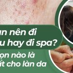 Bị mụn nên đi da liễu hay đi spa? Lựa chọn nào là tốt nhất cho làn da