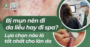 bị mụn nên đi da liễu hay spa