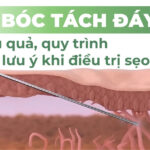 Bóc tách đáy sẹo: hiệu quả, quy trình và lưu ý khi điều trị sẹo rỗ