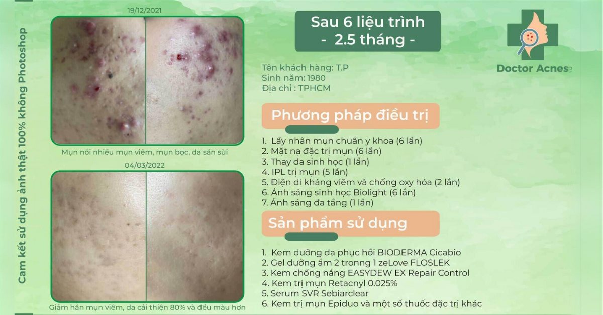 ca lâm sàng điều trị mụn bọc