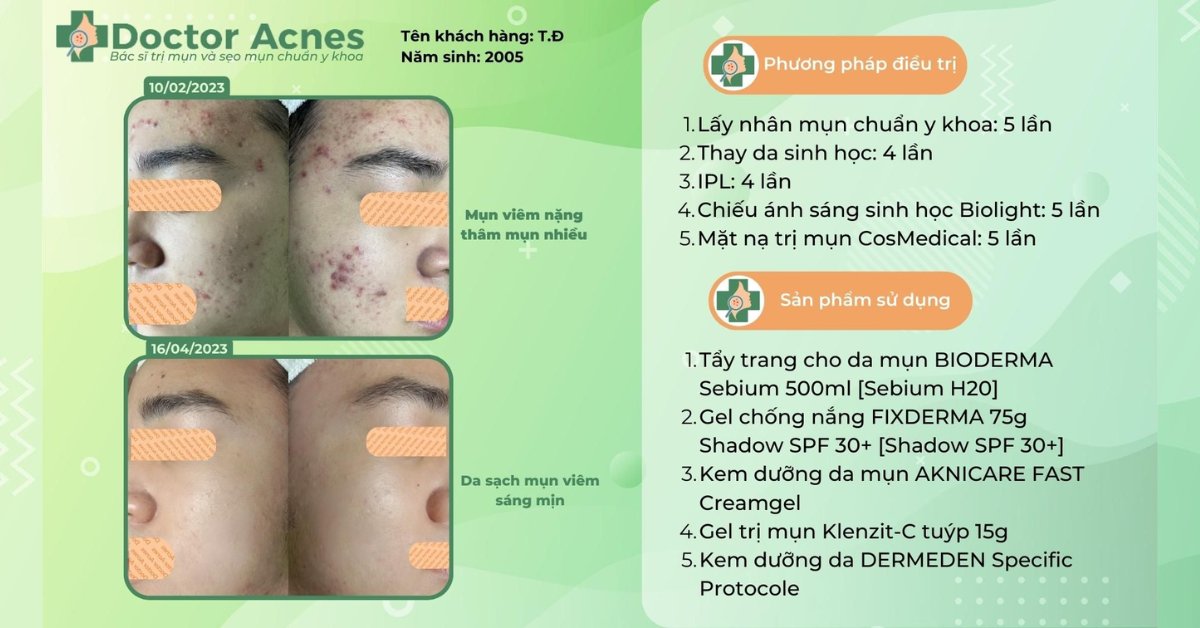 ca lâm sàng điều trị mụn có peel da