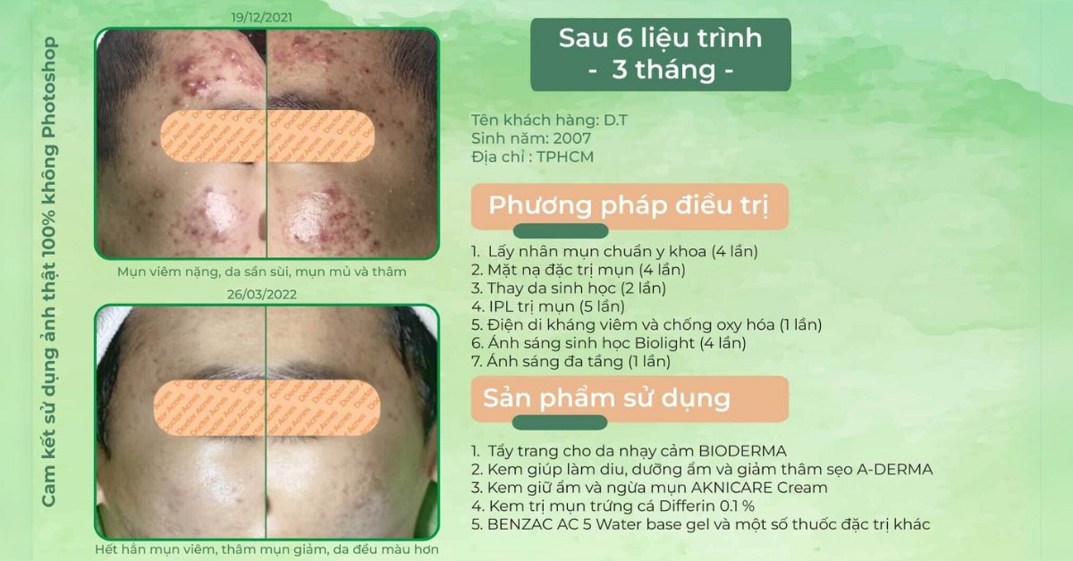 ca lâm sàng điều trị mụn mủ sưng to