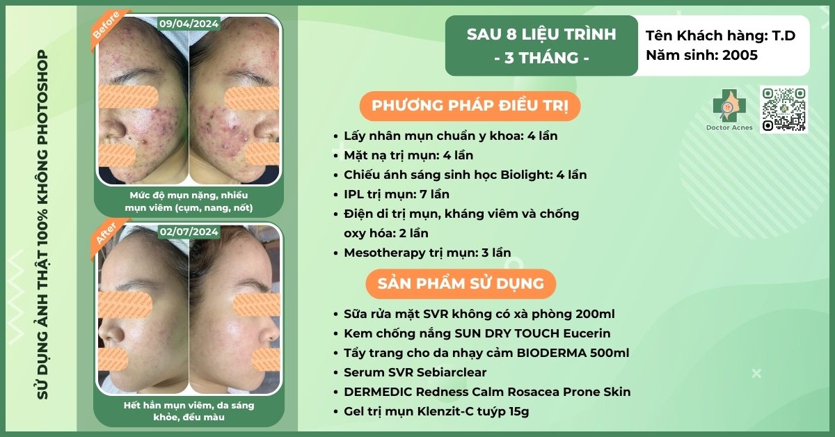 ca lâm sàng điều trị mụn thành công