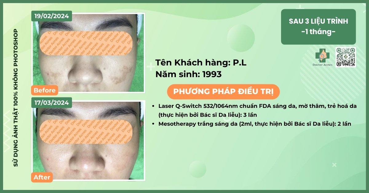 ca lâm sàng điều trị tăng sắc tố sau peel