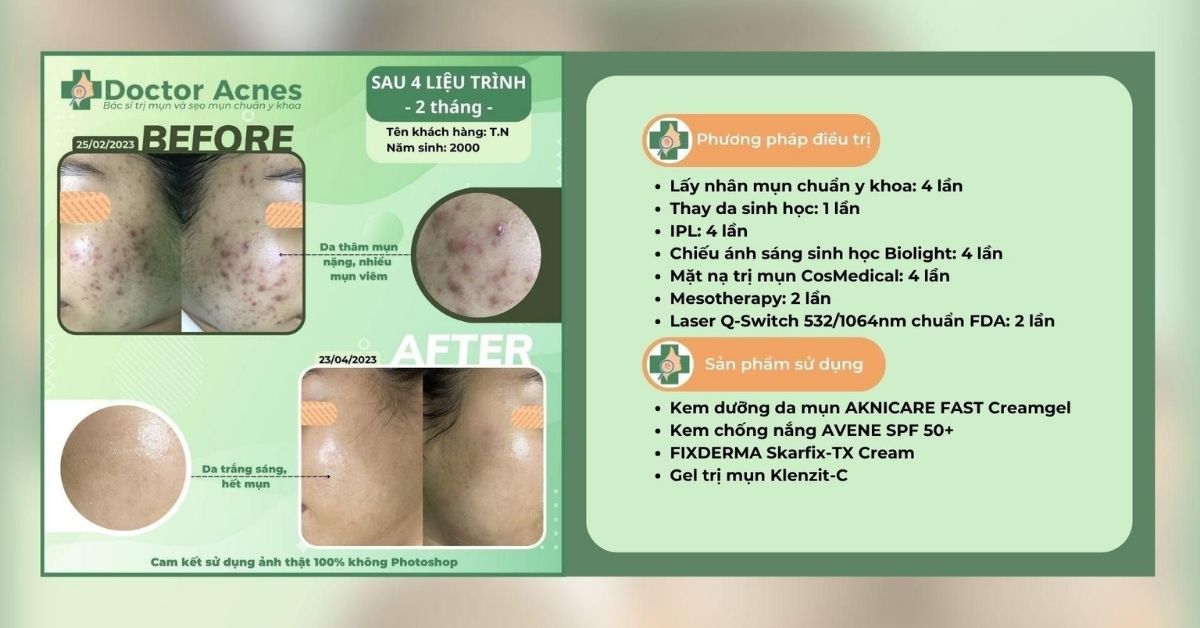 ca lâm sàng trị mụn thành công tại doctor acnes