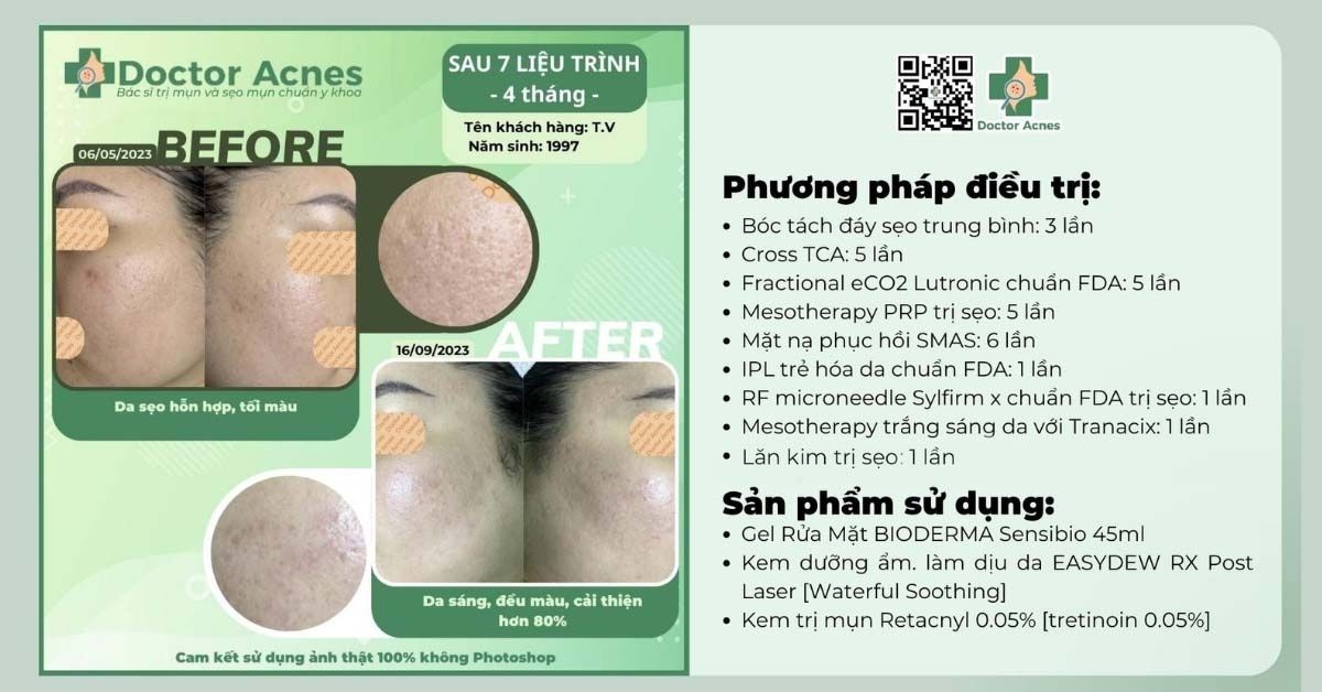 ca lâm sàng trị sẹo